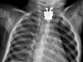 A toddler's X-ray with a Spongebob pendant