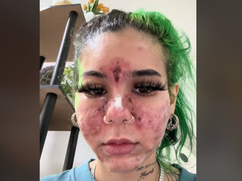 A young woman with face burns