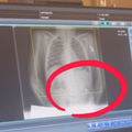 An x ray showing an earring inside the nose of a toddler